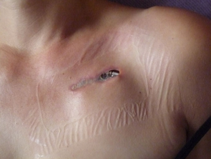 komplikacije pejsmejker